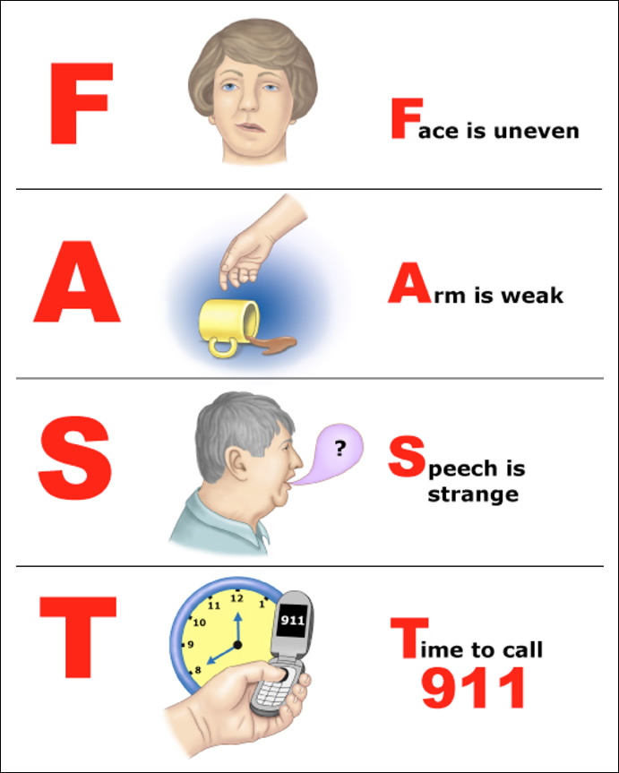FAST Stroke Recognition Rotary Club Of Detroit Lakes Breakfast