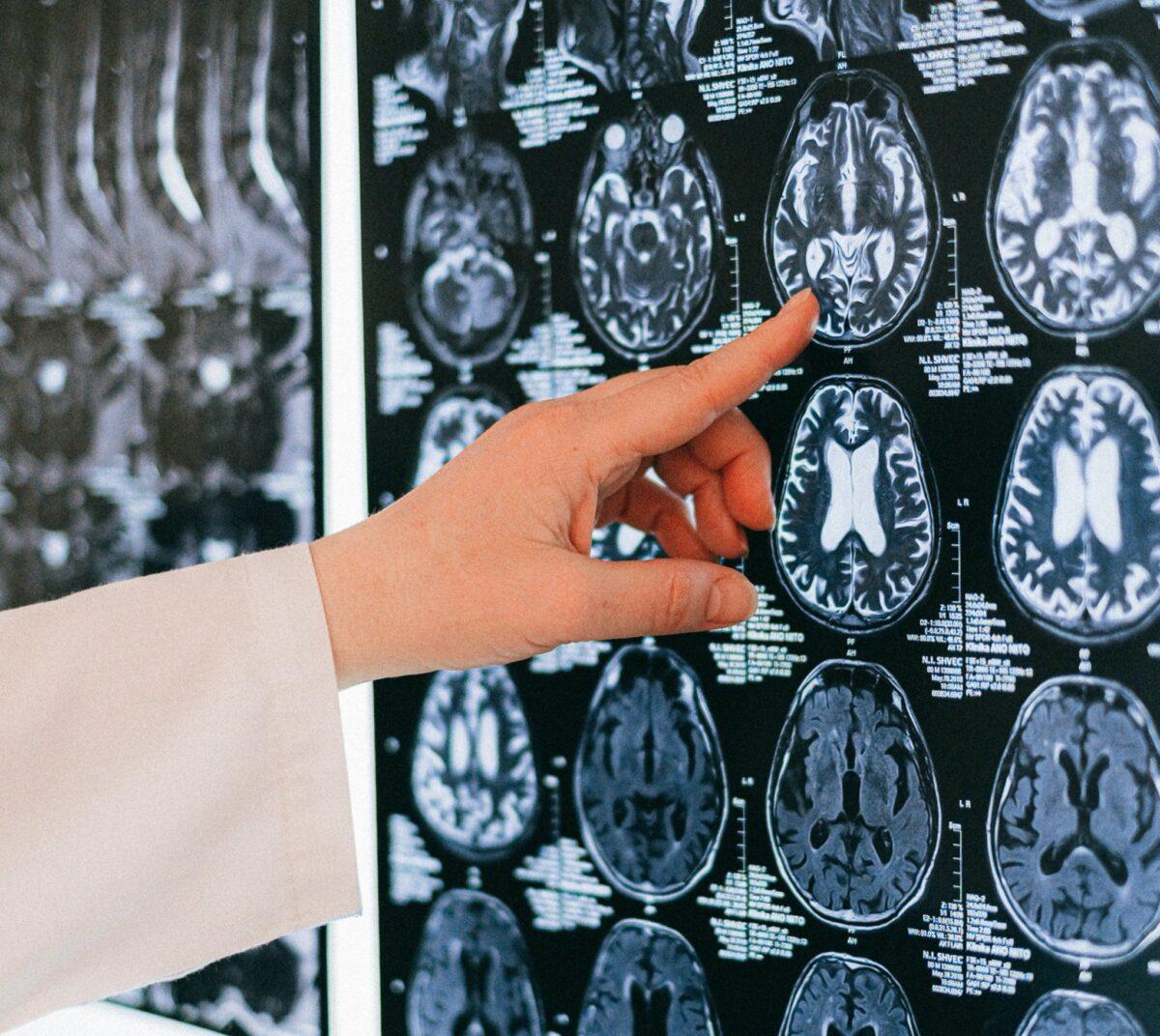 A New Treatment for Stroke Patients