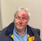 A person with blood on his faceDescription automatically generated